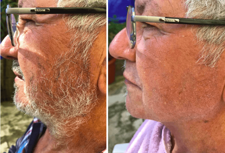 Comparativo da barba antes e depois do uso do One Blade